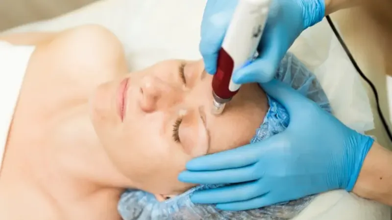 Micro-Needling